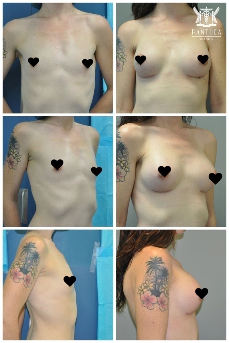 Breast augmentation by Dr Ross Farhadieh
