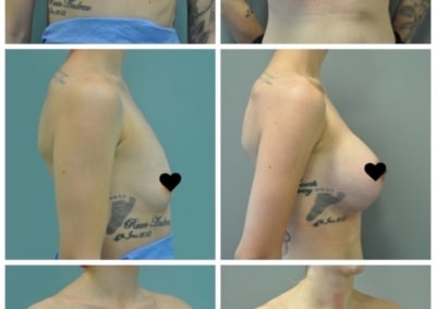 Breast augmentation by Dr Ross Farhadieh