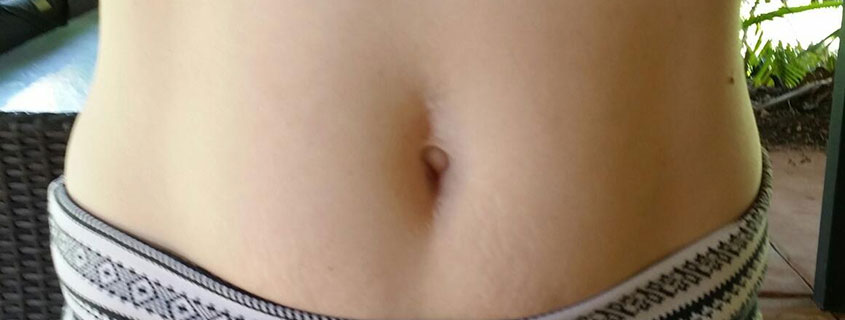 Rachel’s Belly Button Surgery from Outie to Innie with Dr Mark Hanikeri