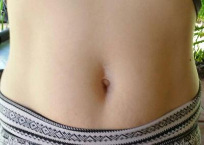 Rachel's belly button surgery