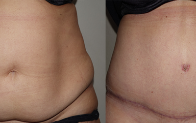 Olivia’s post pregnancy Tummy Tuck Patient Story with Dr Craig Rubinstein