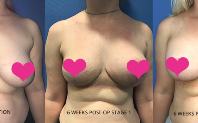 Megan’s Breast Surgery Patient Story – a warning to to “Do Your Research”