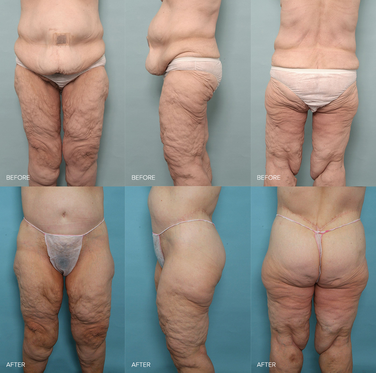 Loose Skin Removal after weightloss by Dr Briggs