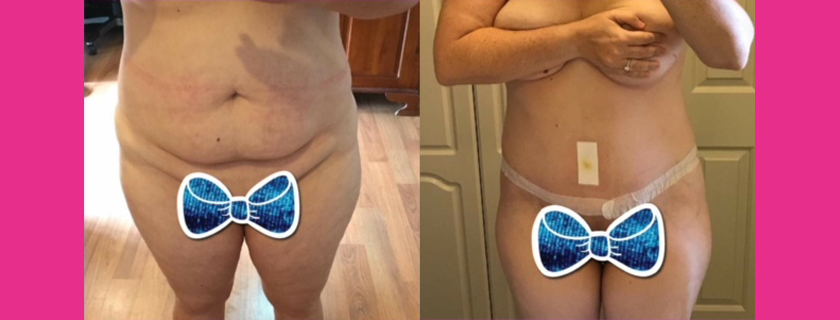 I have Lupus and had an Abdominoplasty OMG here’s what happened … thanks Dr Pyragius!