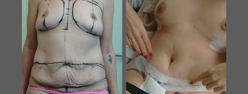 Samantha’s Breast Augmentation, Extended Tummy Tuck and Revision Surgery with Dr Marcus Pyragius