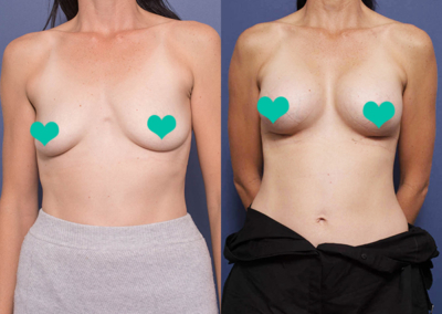 breast implant rotation
