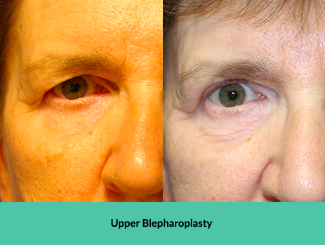Upper Blepharoplasty