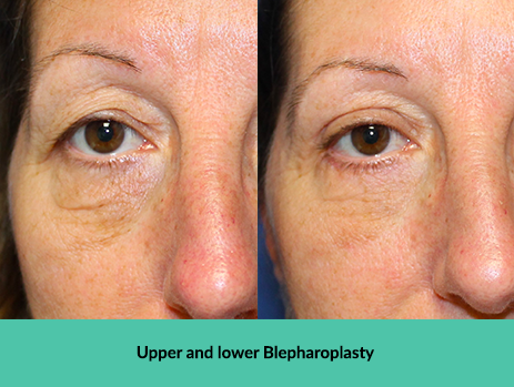 Upper and lower Blepharoplasty