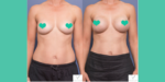 Breast Cancer Patients Wanting Breast Reconstruction