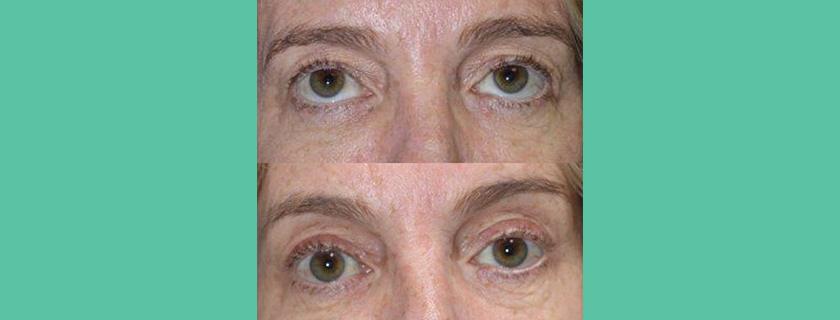 Lynn’s Blepharoplasty and Brow Lift with Dr Craig Layt on the Gold Coast