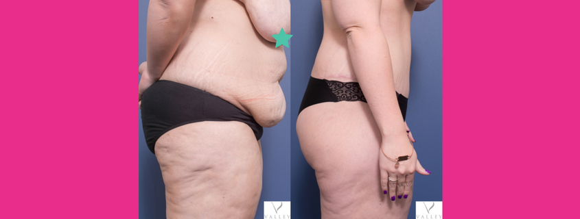 A Step by Step Guide to the Tummy Tuck with Dr Matthew Peters