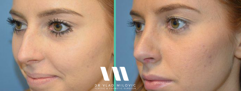Ultrasonic Rhinoplasty getting more precise results with Dr Vlad Milovic
