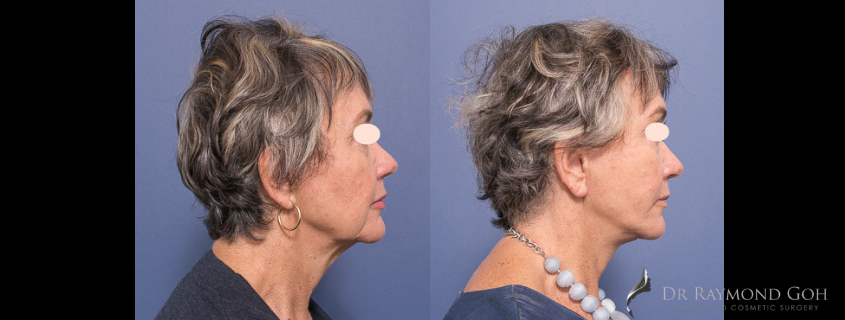 Facelift and Necklift – When is the right time and is it right for me?