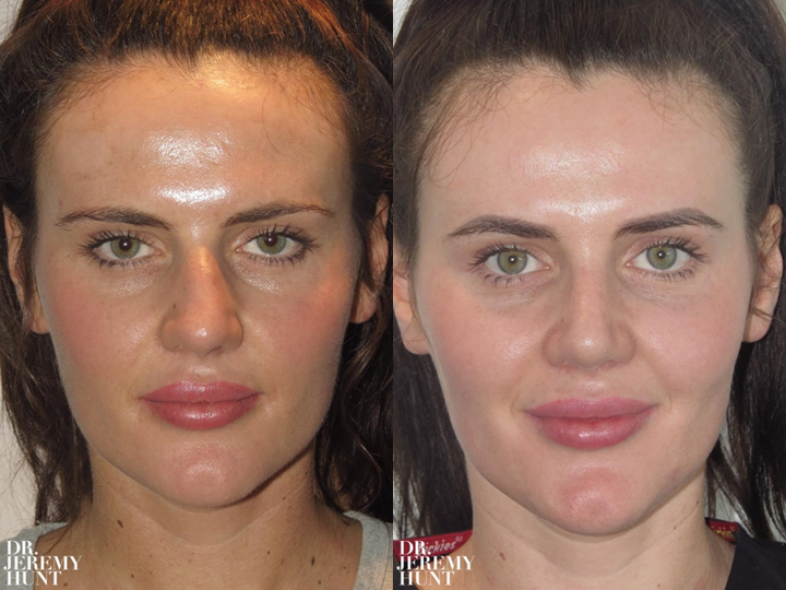 From Big to Beautiful Rhinoplasty Recovery Time