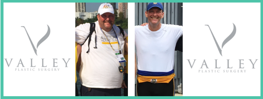 Paul’s Massive Weight Loss and Belt Lipectomy with Dr Matthew Peters