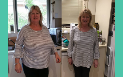 Sue’s Breast Reduction Patient Story with Dr Craig Rubinstein