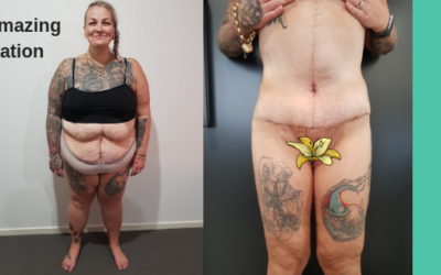 Amanda’s Body Lift with Dr Justin Perron – after massive weightloss