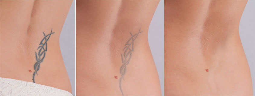 Healing After Your Tattoo Removal Procedure – What To Expect