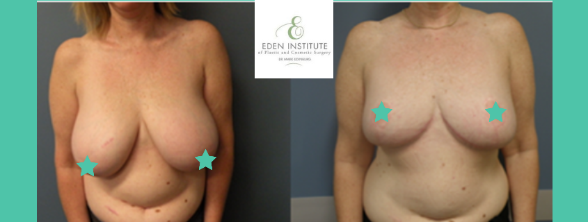 Breast Reduction Patient Story with Dr Edinburg – Surgery for Larger Breasts