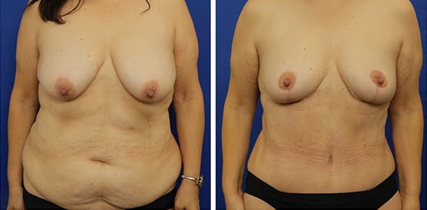 Breast Reduction and Tummy Tuck
