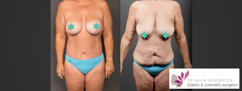 Dr Gavin Sandercoe’s Body Lift – Surgery for Excess Skin Removal