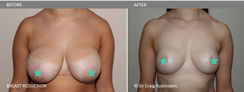 Does Medicare Cover Breast Reduction or Breast Lift Surgery?