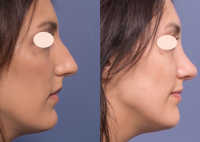 Rhinoplasty in Brisbane by Dr Raymond Goh from Valley Plastic Surgery