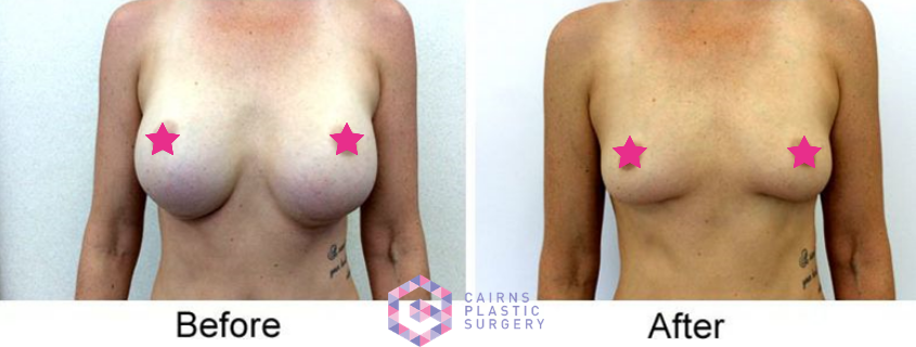 What is enBloc? Breast Explant or Breast Implant Removal…