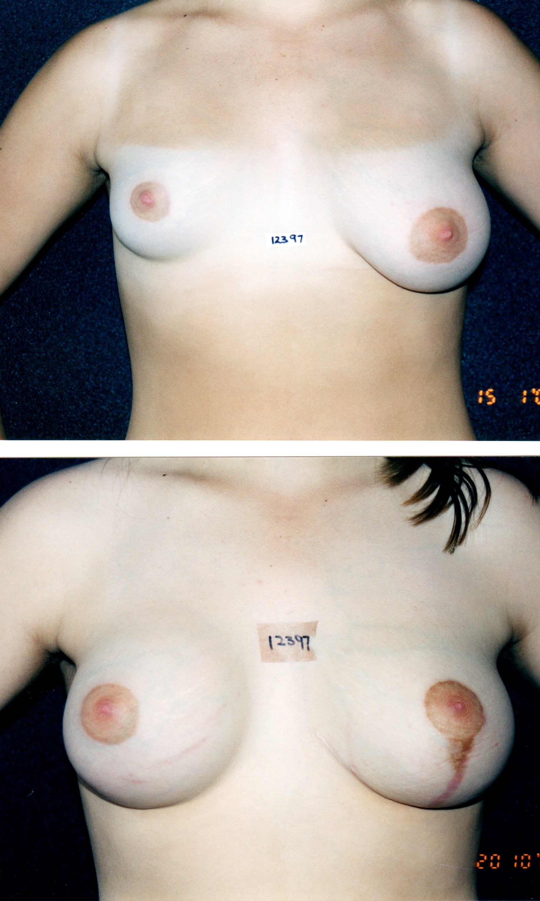 Breast nipple deformity