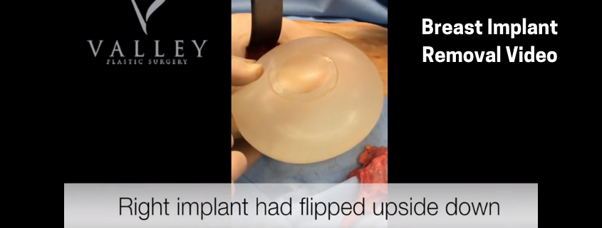Breast Implant Removal Video