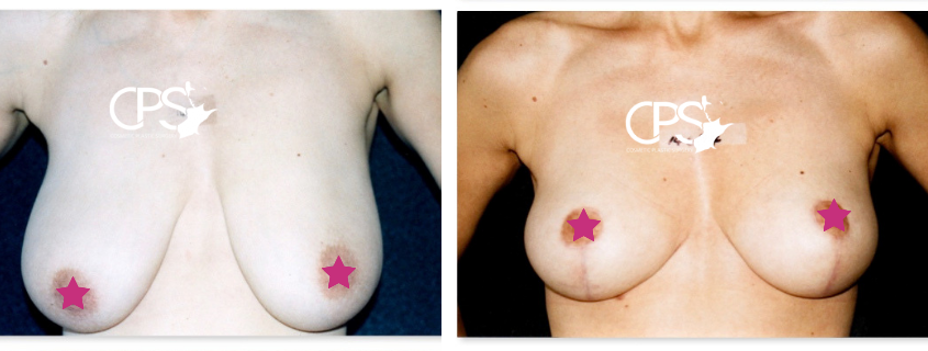 Breast and Nipple Deformity – Asymmetry, tubular, inverted, oversized…