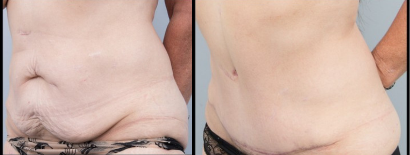 Your Reconstruction Program – Weight Loss and Excess Skin Procedures Planning