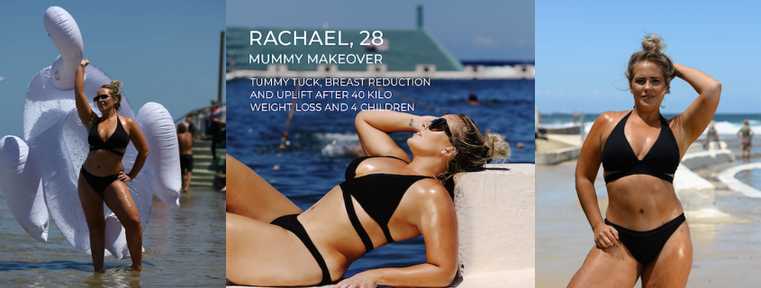 Rachael’s Mummy Makeover with Dr Nicholas Moncrieff – a Life Changing Journey