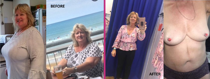 Sue’s Transformation – Sue’s weight loss journey with Dr Craig Rubinstein