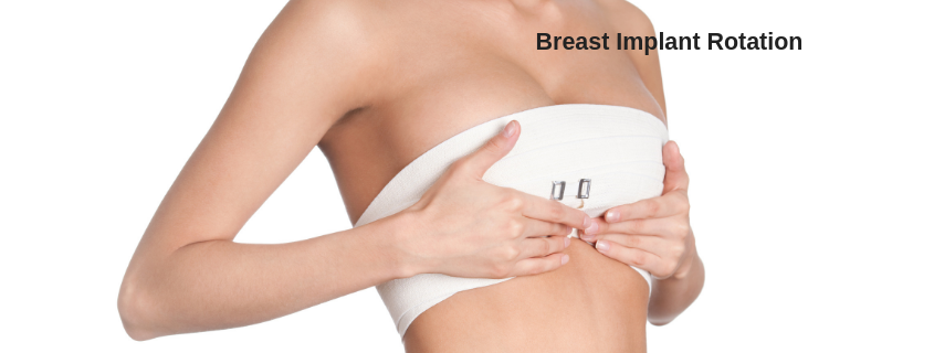 Breast Implant Rotation