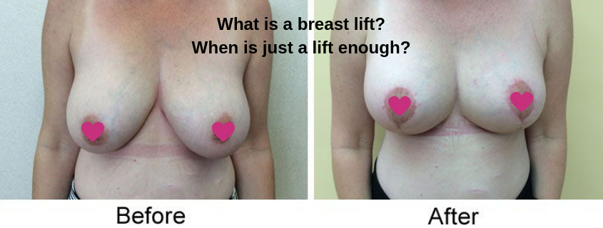 What is a breast lift? When is just a lift enough?