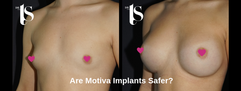 Plastic Surgeon Dr Terrence Scamp talks about the Benefits of Motiva Implants