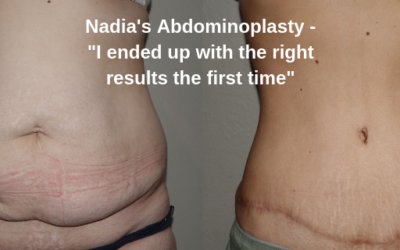 Nadia’s Abdominoplasty Patient Story by Dr Craig Rubinstein