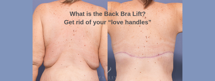 What is the back bra lift? Get rid of your “love handles” with Dr Matthew Peters