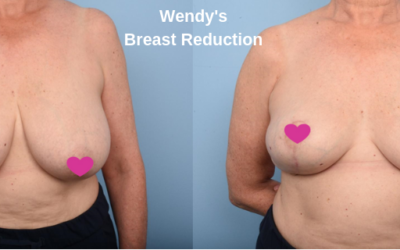 Wendy’s Breast Reduction Patient Story by Dr Patrick Briggs