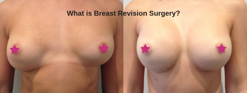 What is Breast Revision Surgery? – With Dr Phil Richardson