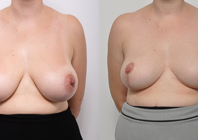 How much is Breast Reduction in Australia