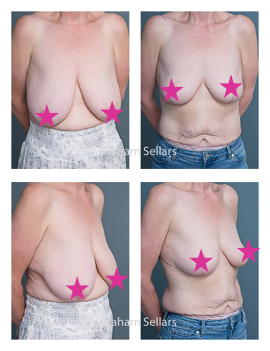 Alison's Breast Reduction