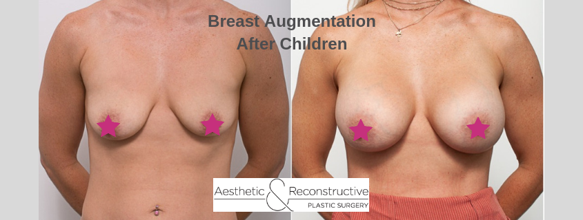 Breast Augmentation After Children