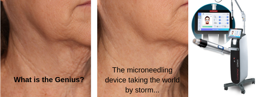What is the Genius? The radio-frequency microneedling device taking the world by storm…