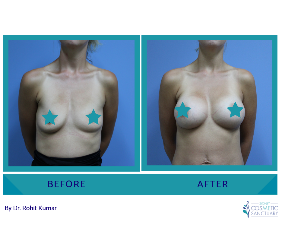 breast fat transfer augmentation
