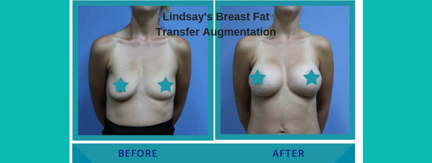 Lindsay’s Breast Fat Transfer Augmentation