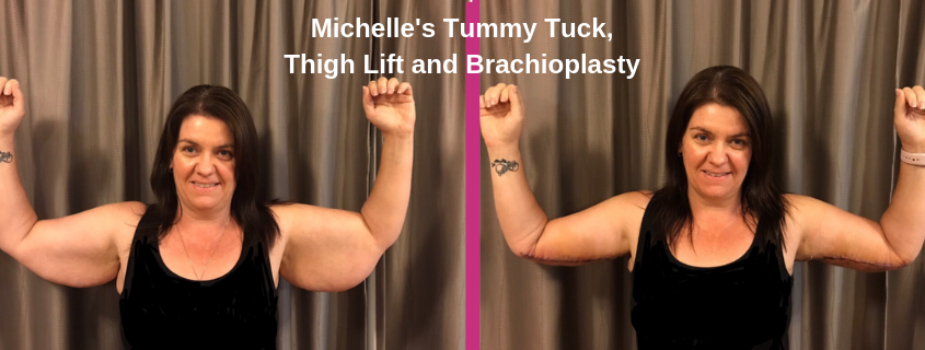Michelle’s Tummy Tuck, Thigh Lift and Brachioplasty with Dr Amira Sanki