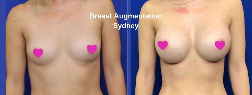 Breast Augmentation Sydney with Dr Pouria Moradi