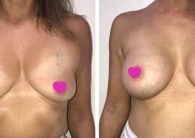 Breast Augmentation Sydney